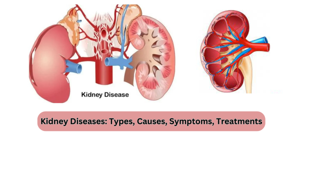 Kidney Diseases Types, Causes, Symptoms, Treatments